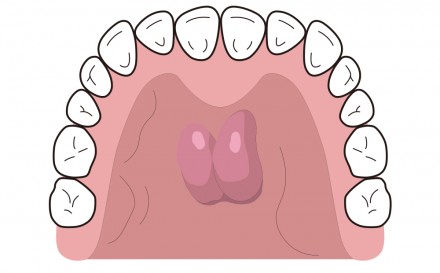 上顎の内側 真ん中あたりにできる