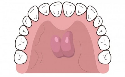上顎の内側 真ん中あたりにできる