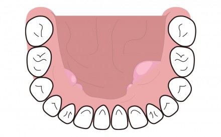 下顎の内側 歯列に沿ってできる