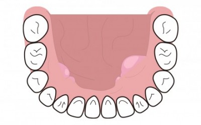 下顎の内側 歯列に沿ってできる