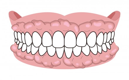 外側の歯茎にそってできる