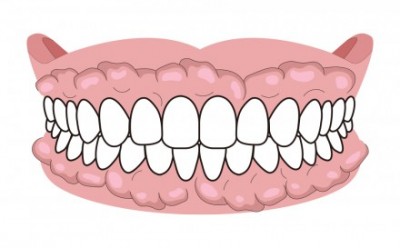 外側の歯茎にそってできる