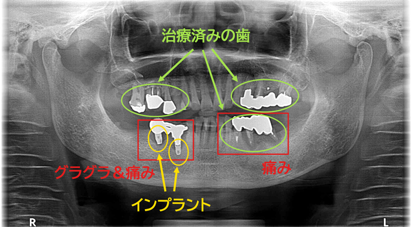 セカンドオピニオンにて当院を受診した際のレントゲン写真