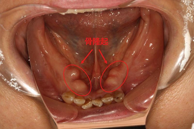 口腔内写真（下顎）