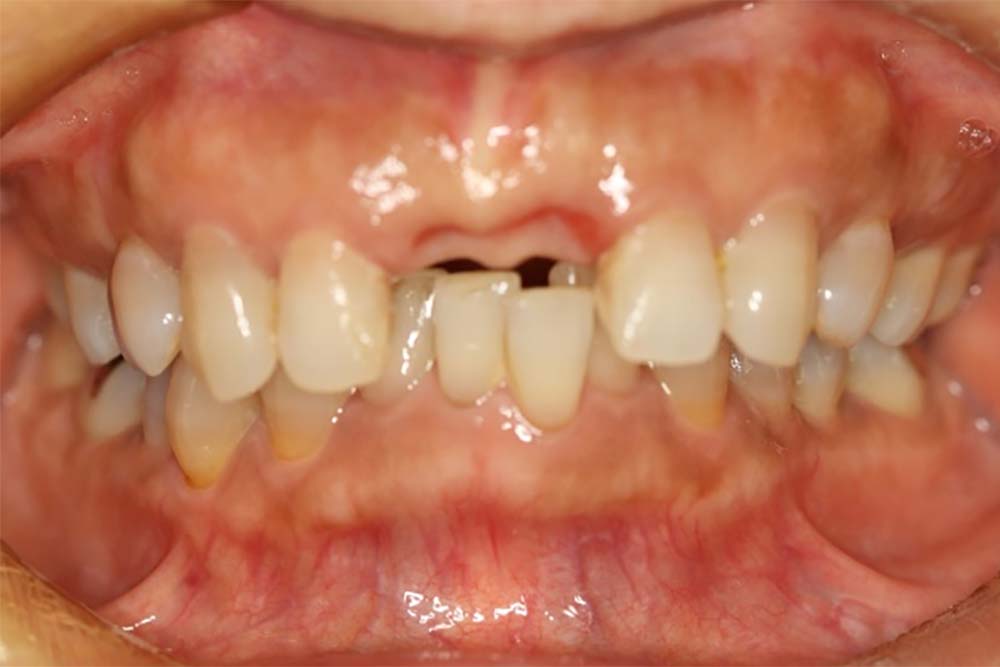 front-teeth-implant-case1-2