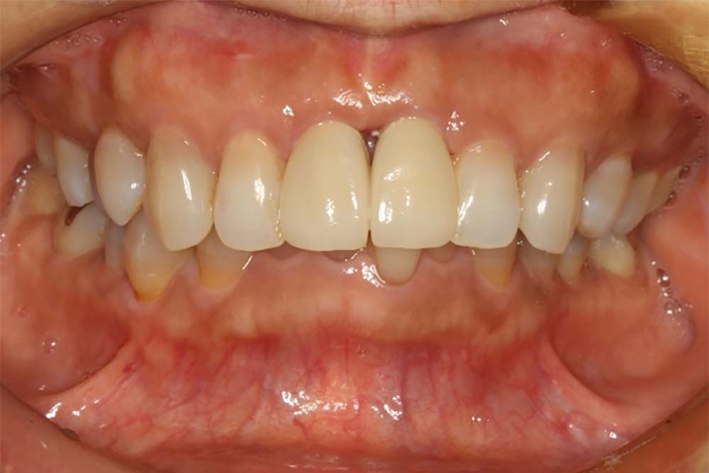 front-teeth-implant-case2-2