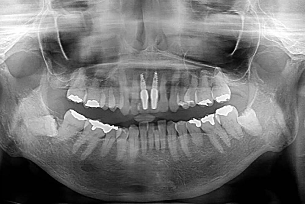 front-teeth-implant1