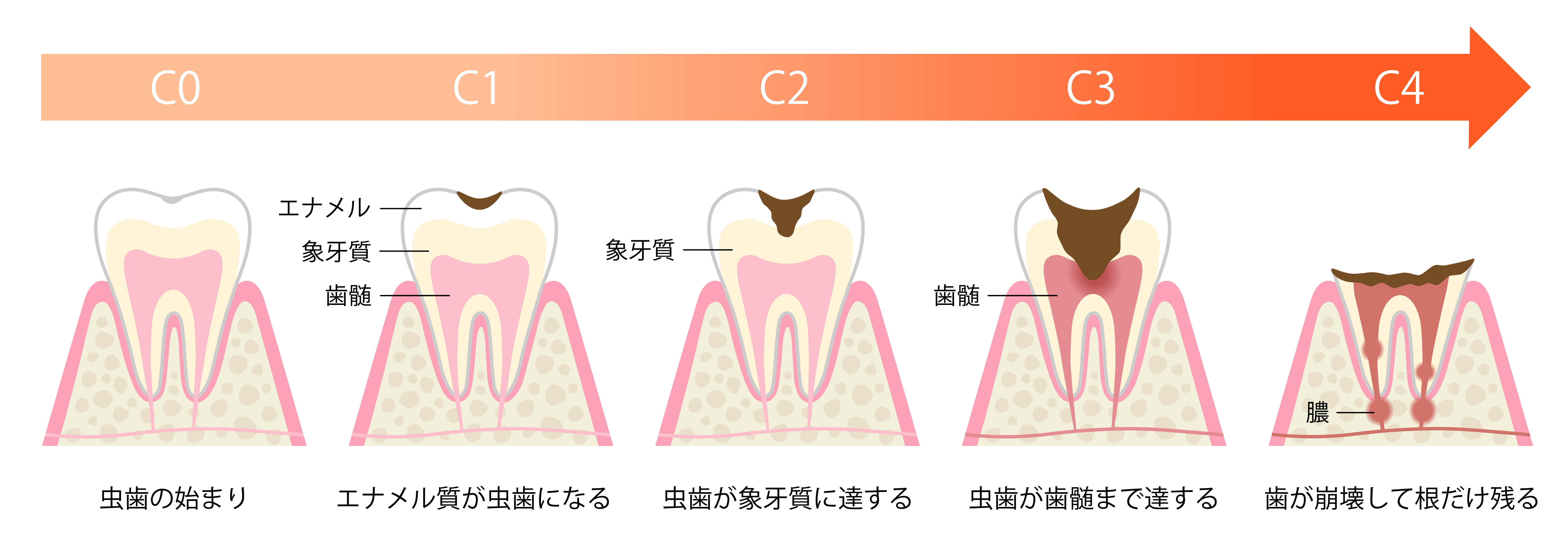 虫歯の進行と症状